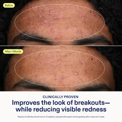 Skinfix Adapinoid Gel mini application shows slow-release retinoid action