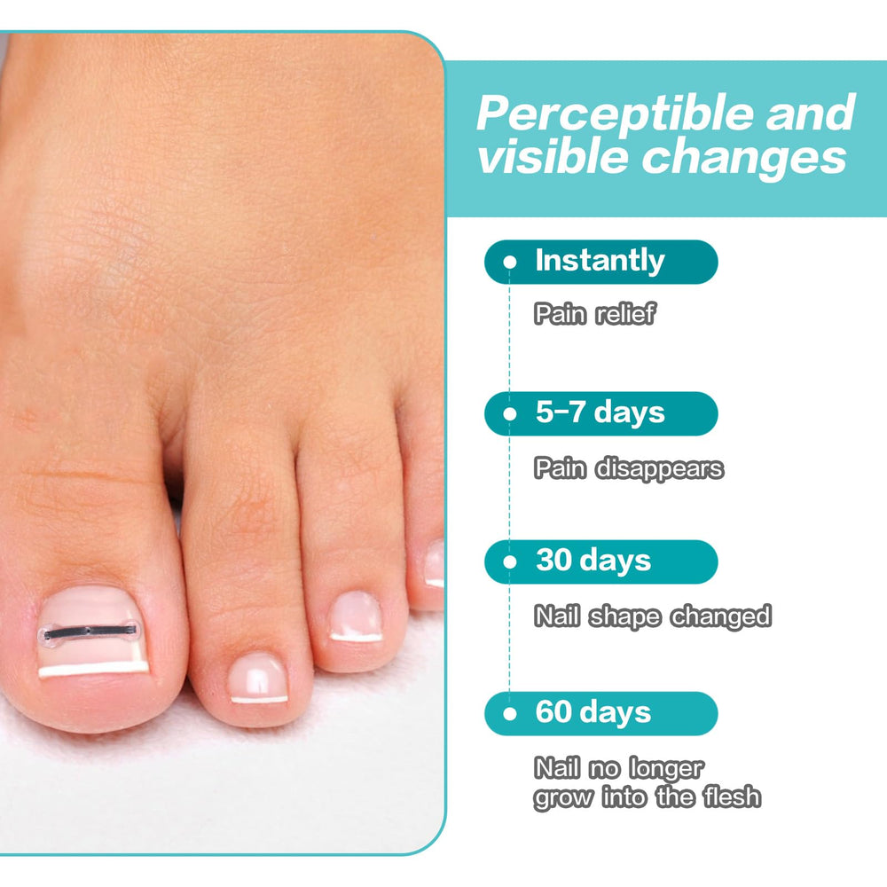 SOAOP patch-assisted application for secure nail correction.