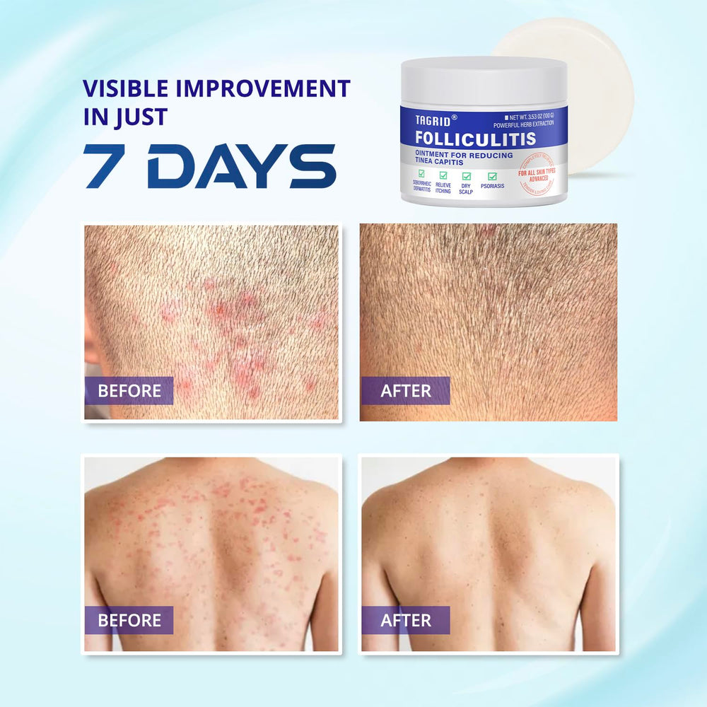 TAGRID Folliculitis Cream jar and packaging highlighting product details.
