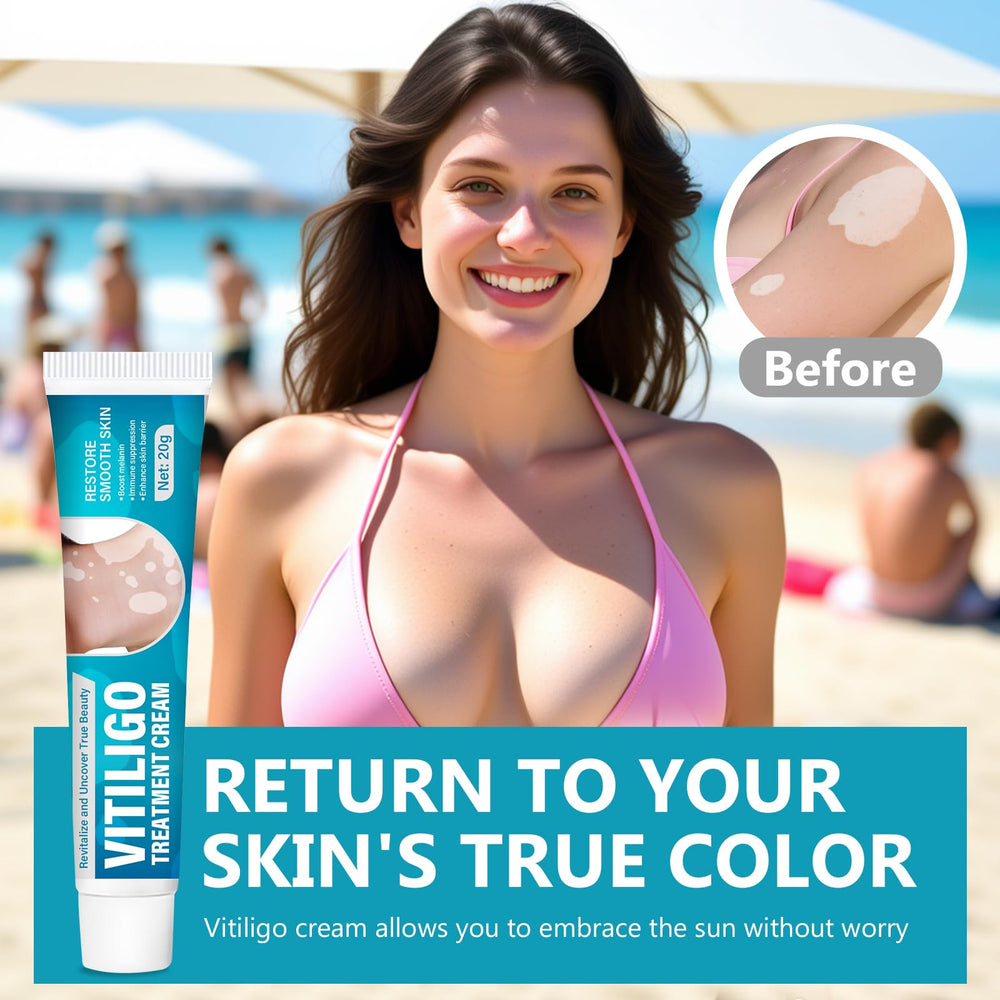 TDZLDM Vitiligo Cream applied to the arm for targeted skin care.