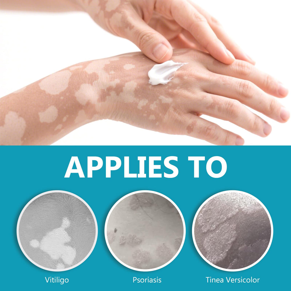 TDZLDM Vitiligo Cream on the face area aiming for even tone.