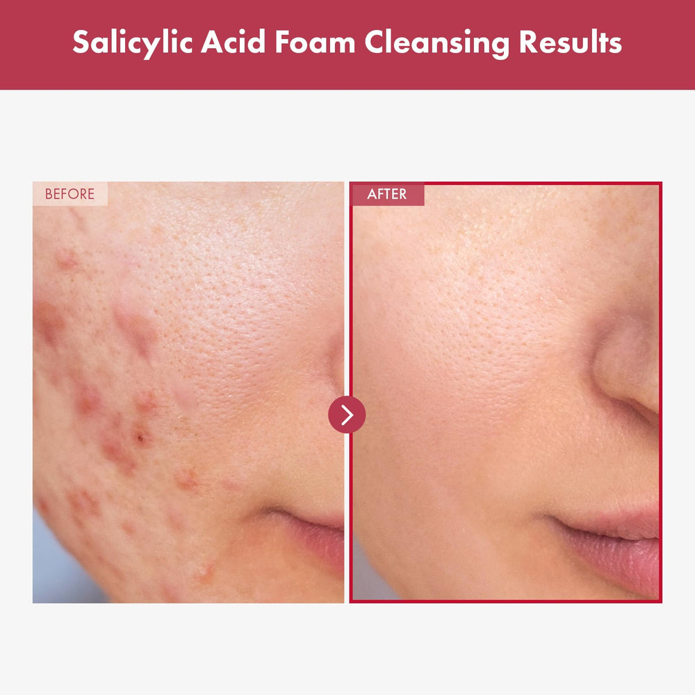 TOSOWOONG Salicylic Acid Foam Cleanser foamy lather demonstrates exfoliation for smoother skin