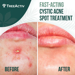 TreeActiv cystic acne spot treatment applied on skin demonstrates on-the-spot care potential.