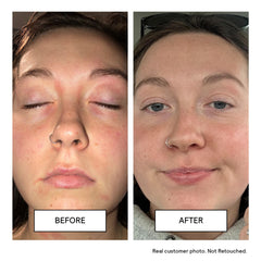 Applying Untoxicated Face Wash during routine to cleanse gently.