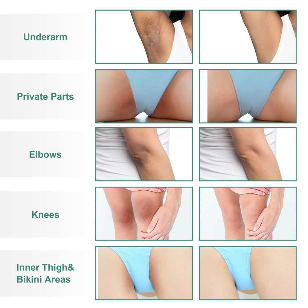 Vcetree cream for knees brightens dull skin and evens tone