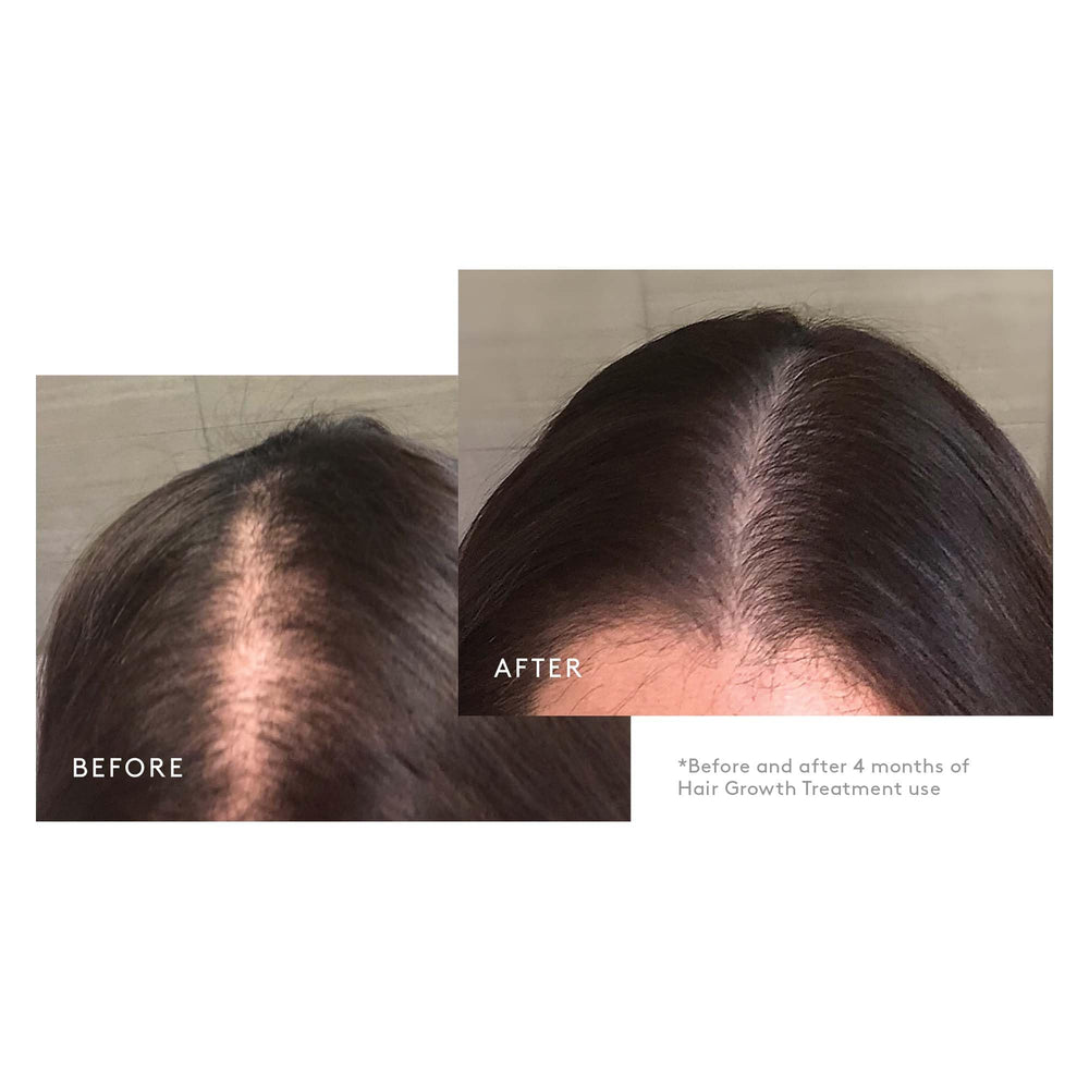 Virtue Minoxidil foam dispenser in hand, targeted thinning hair support.