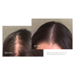 Virtue Minoxidil foam dispenser in hand, targeted thinning hair support.
