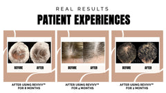 Scalp application using Revivv serum for twice-daily routine