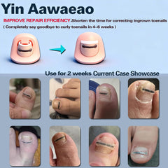 At-home correction process with Yin Aawaeao for toenail care