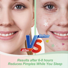 YIWMWIY hydrocolloid adhesion stays in place overnight shielding blemishes.