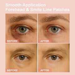 YLOTRE Novalift Micro Eye Patches smooth forehead and smile lines