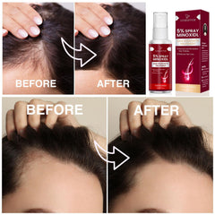 Yzmoffer 5% Minoxidil promotes thicker-looking hair with regular use.
