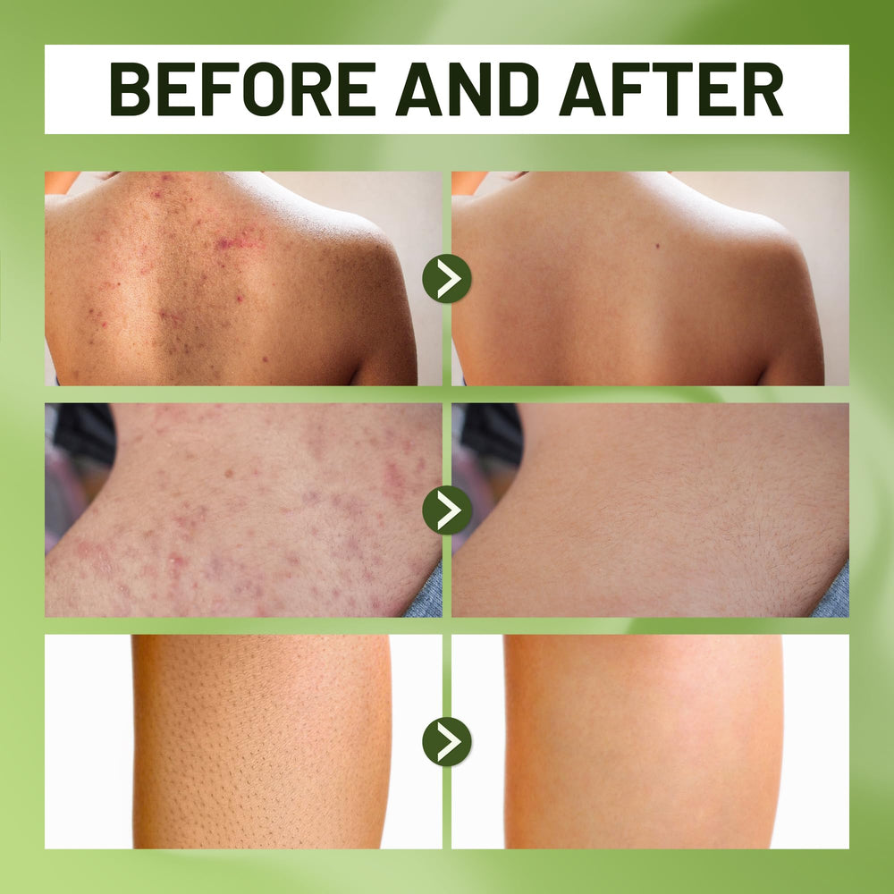 ABERA label highlighting tea tree and bitter melon ingredients