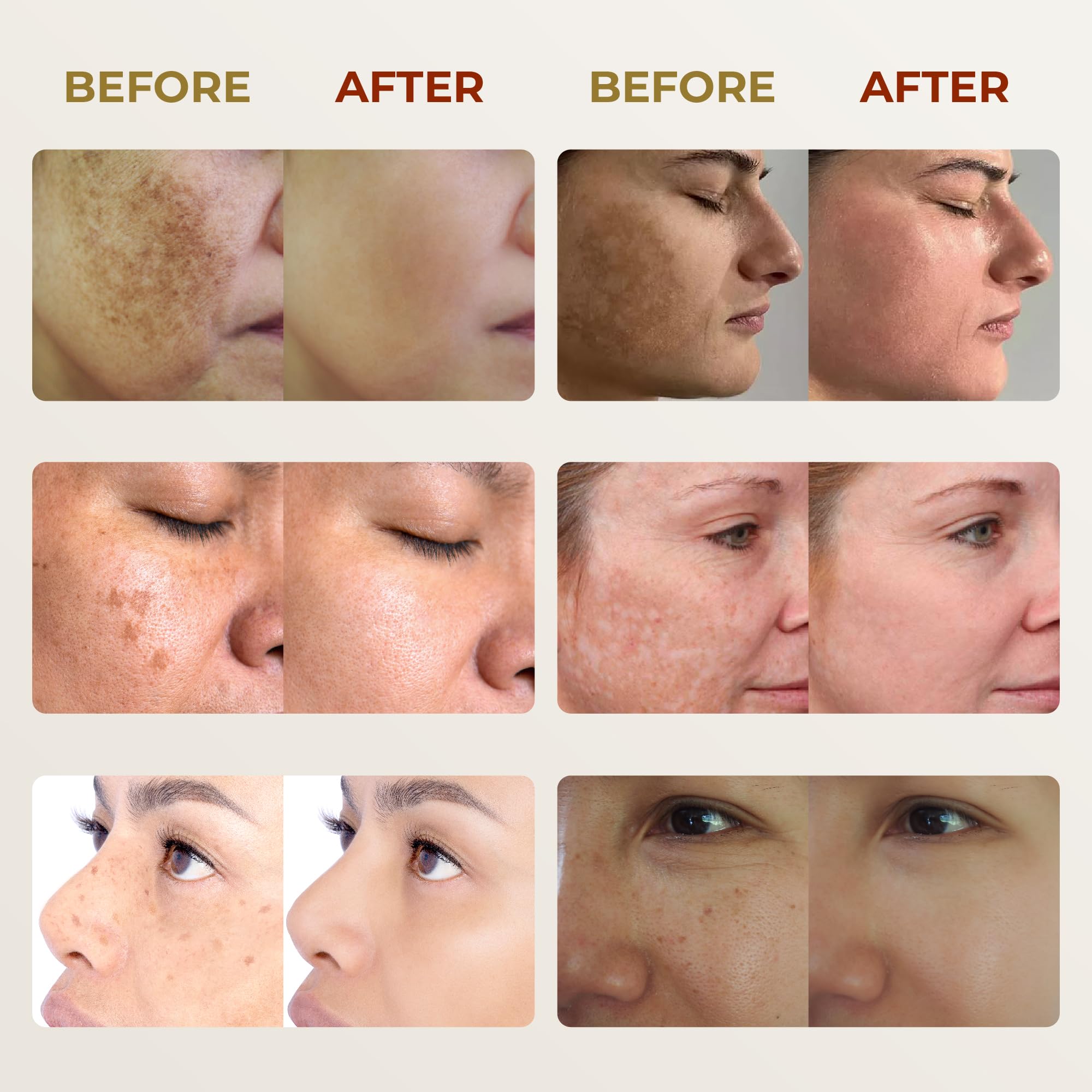 ABERA cream on skin showing freckles and sun spots concept.