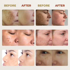 ABERA cream on skin showing freckles and sun spots concept.