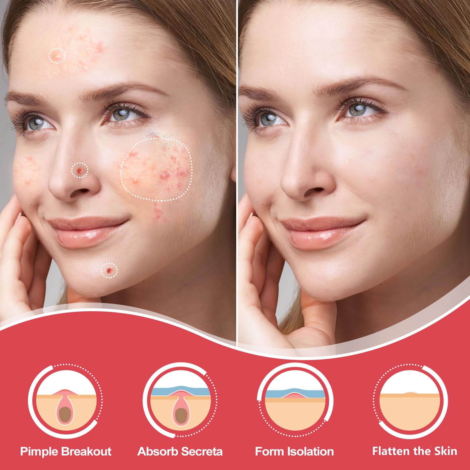 AcneGo hydrocolloid patch sticks securely for overnight wear.