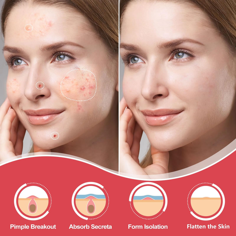 AcneGo hydrocolloid patch sticks securely for overnight wear.