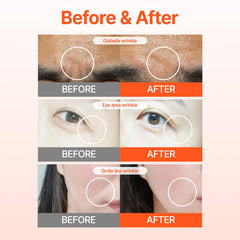 Acropass RETI-RN microcone patch along smile lines for improved texture.