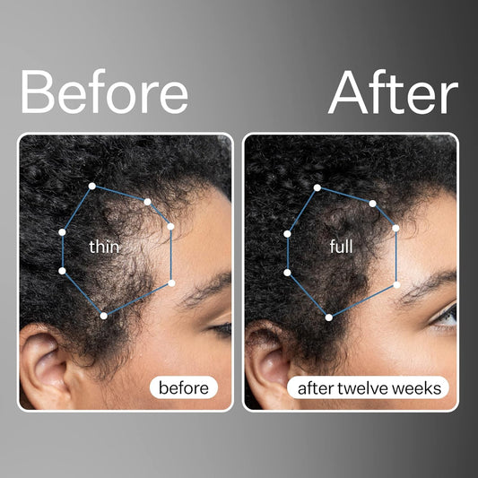 ACT+ACRE stem cell serum pump shown for easy on-scalp application.