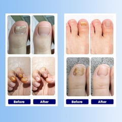 Aedydyce foot nail care patches support moisture balance for damaged nails.