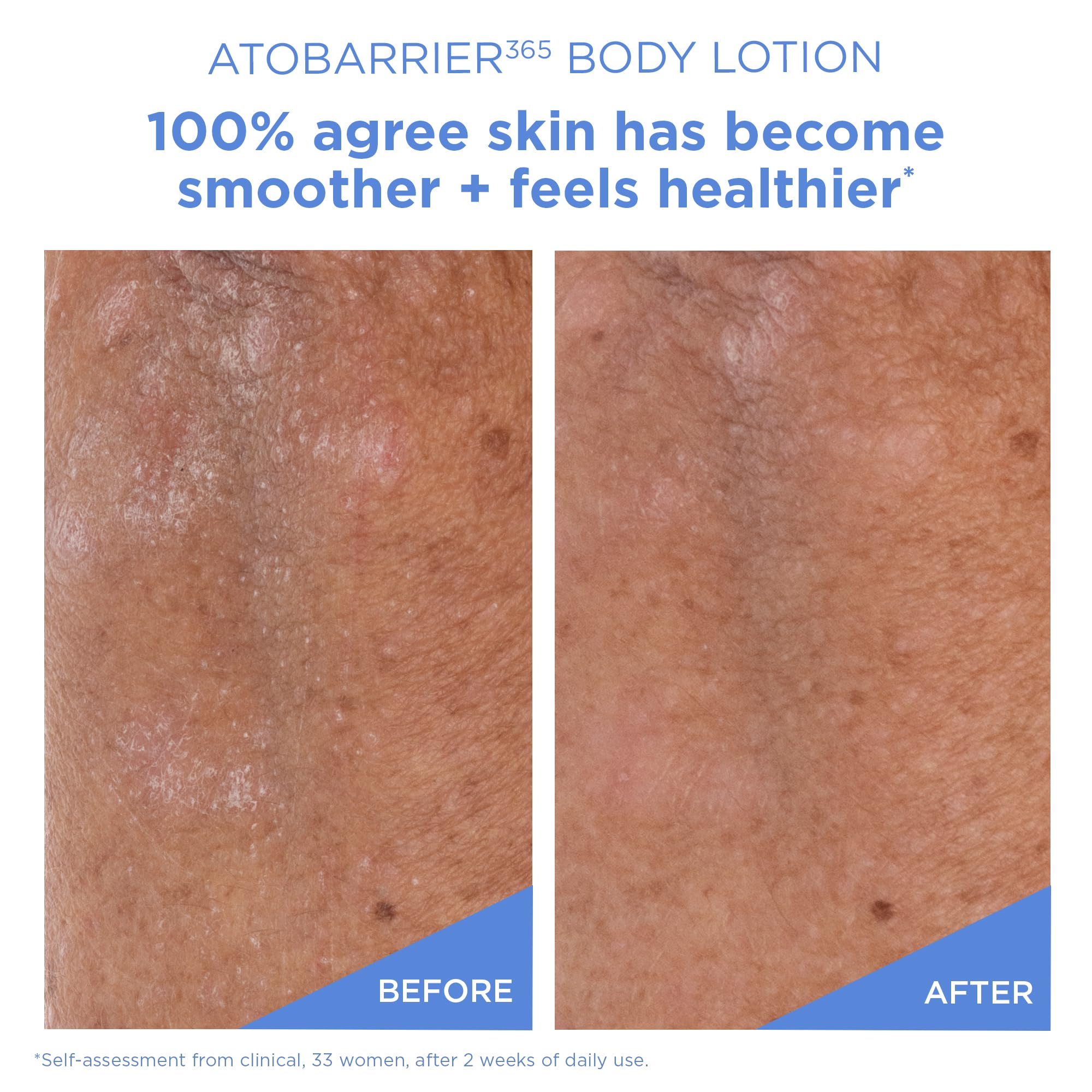 AESTURA ATOBARRIER365 pha exfoliation closeup suggests gentle exfoliation for more even texture.
