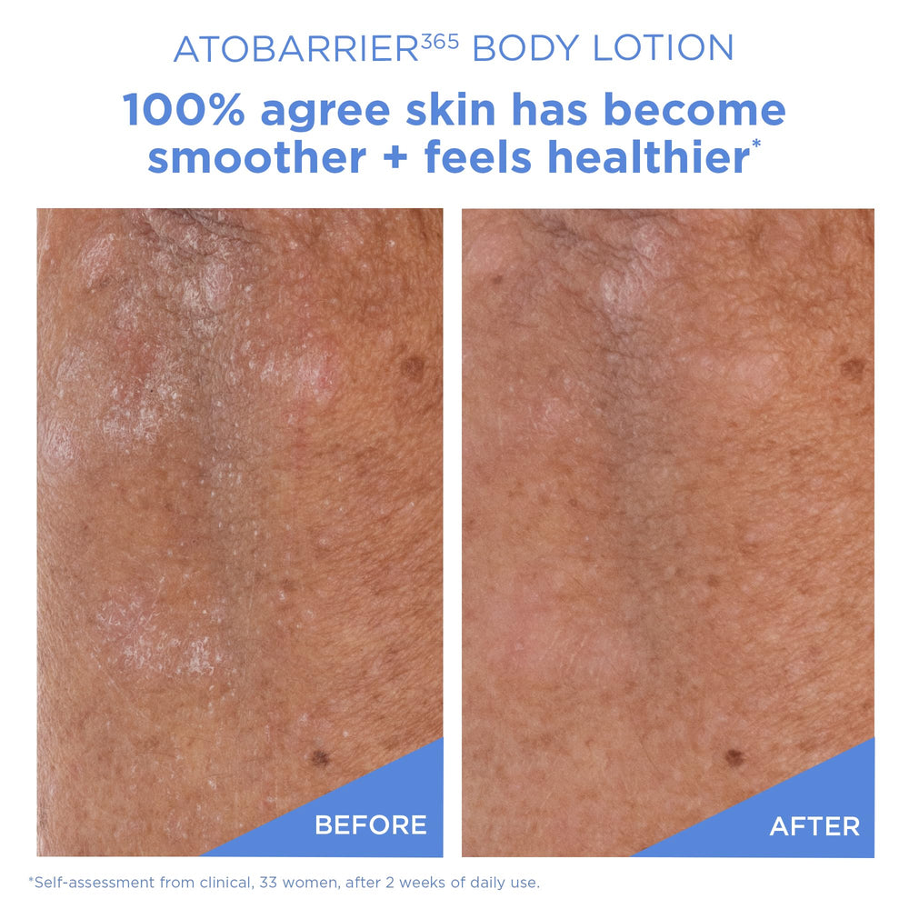 AESTURA ATOBARRIER365 pha exfoliation closeup suggests gentle exfoliation for more even texture.