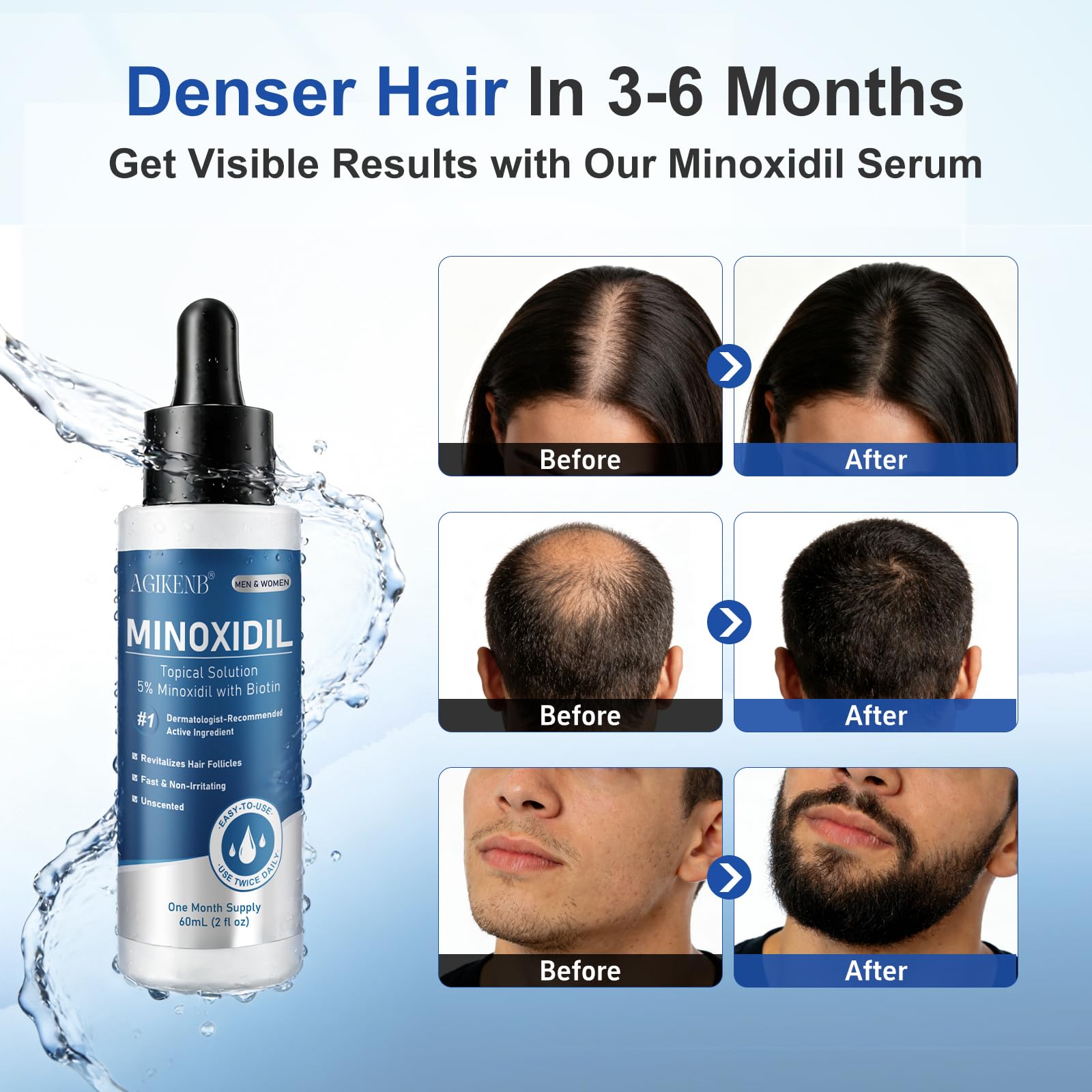 AGIKENB minoxidil for beard area application