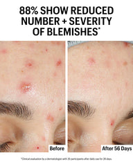 Allies of Skin on rosacea-prone skin aims to calm redness.