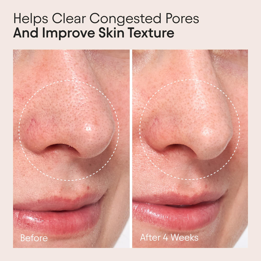 Pores and textured skin magnified to illustrate potential smoothing with Alpyn Clarifying Oil.