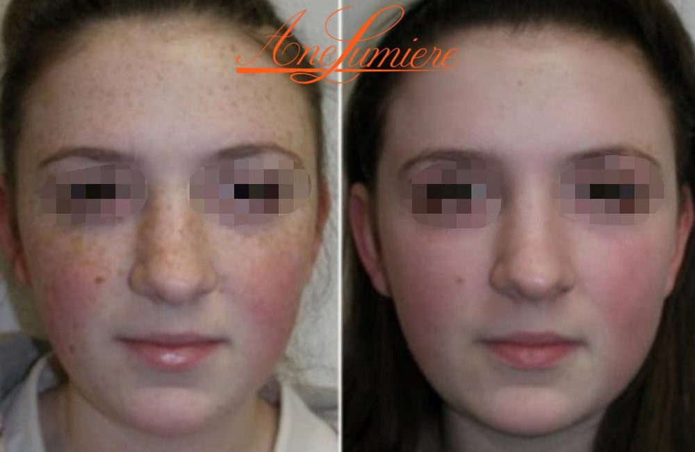 Ane Lumiere Miami Jessner Peel application swatch shows multi-acid exfoliation potential.