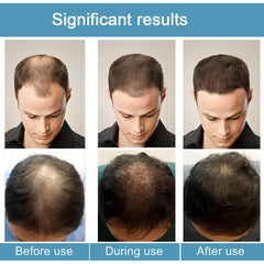 ANEFOSE Hair Regrowth System serum dispense for easy daily scalp care