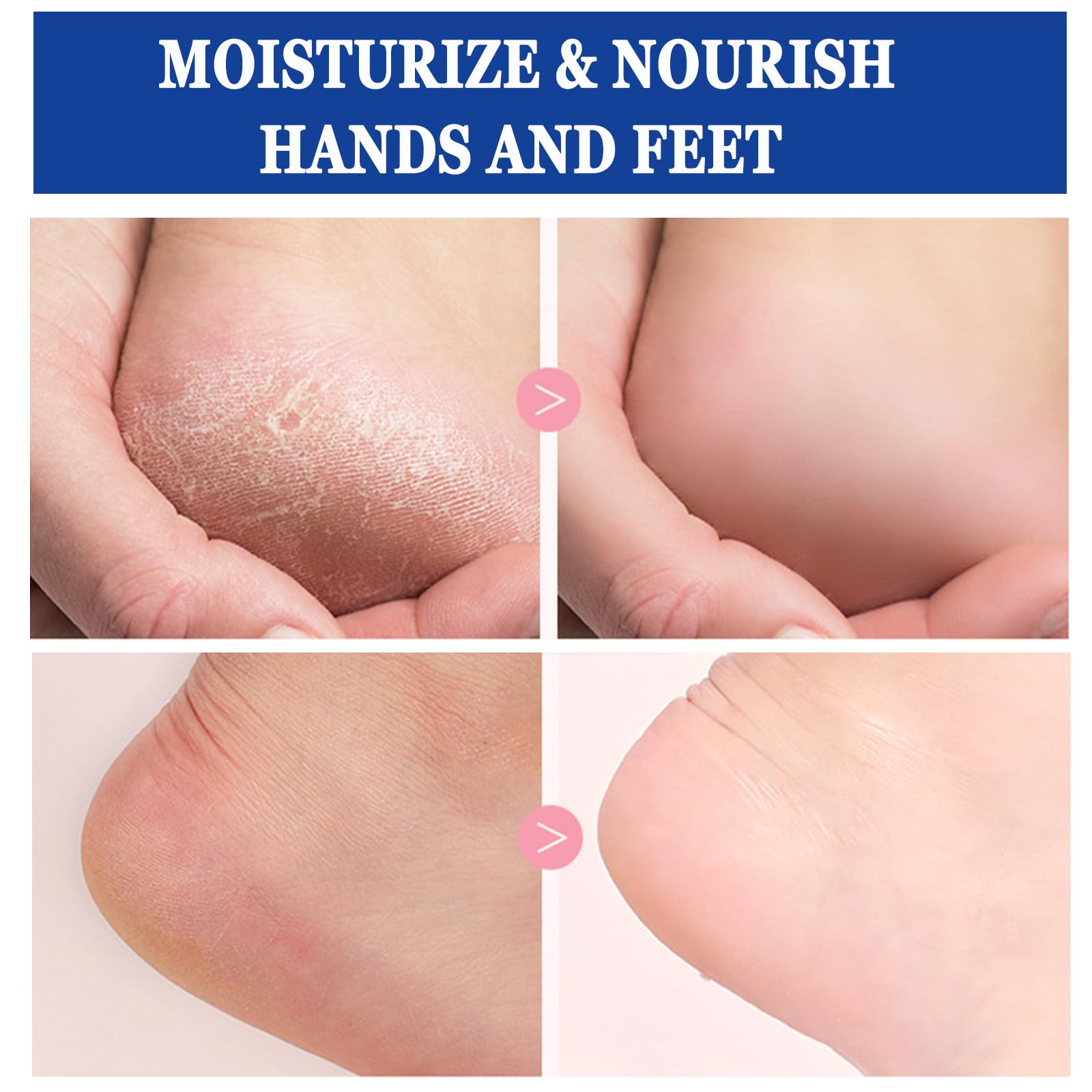 Anweina foot cream with 2% salicylic acid gently exfoliates flaky skin.