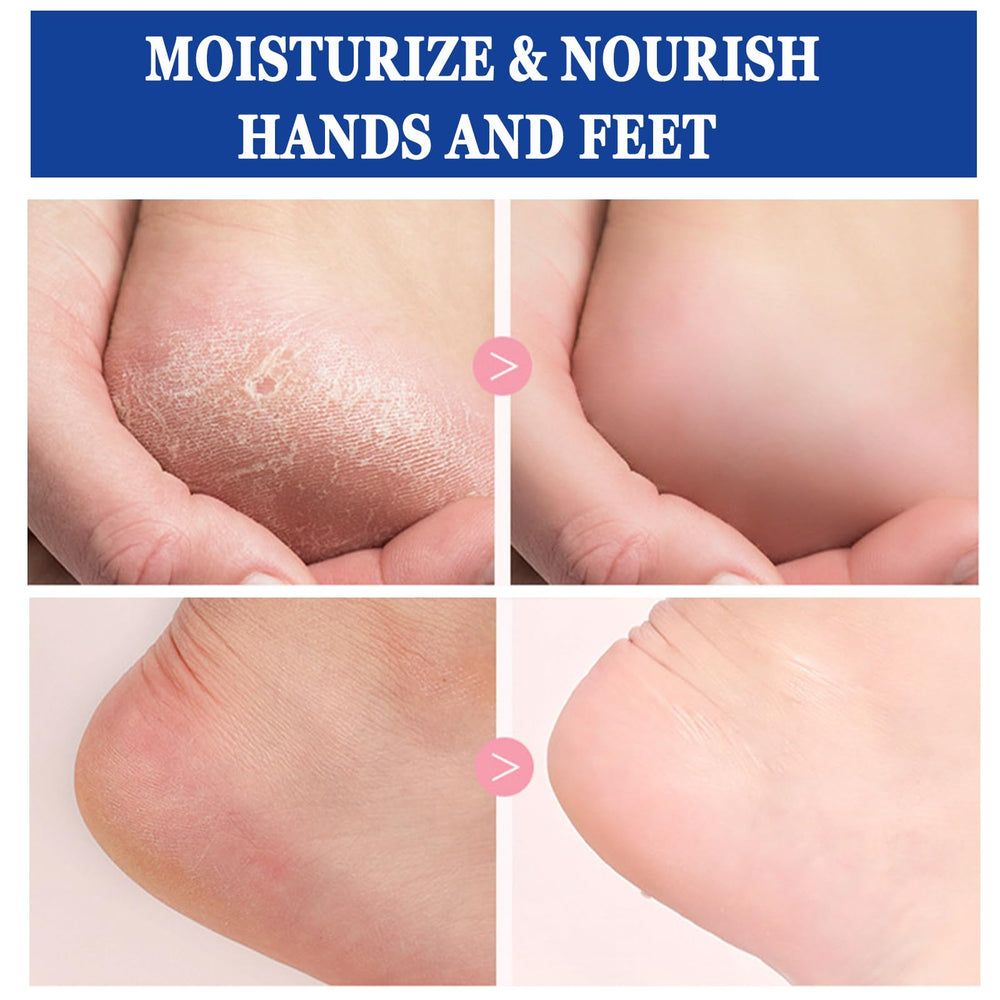 Anweina foot cream with 2% salicylic acid gently exfoliates flaky skin.