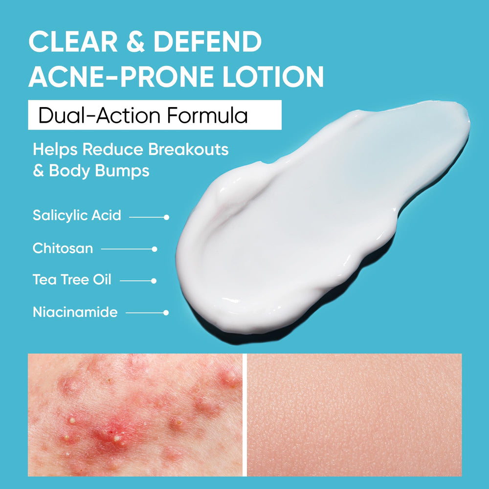 Aobbiy body acne lotion texture improving skin as applied.