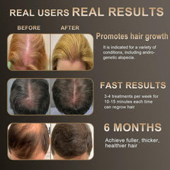 Apbier Laser Hair Growth Comb on scalp delivering focused light for fuller hair