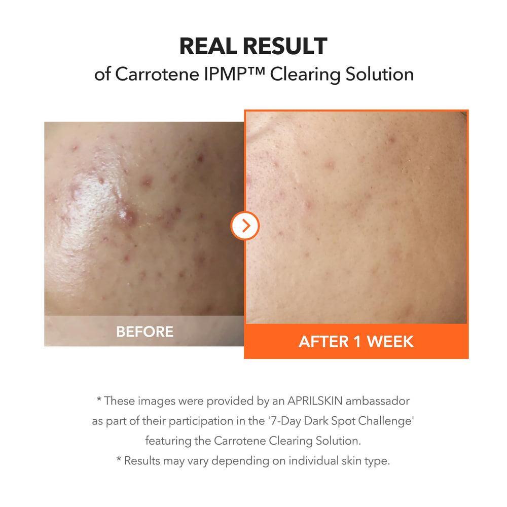 APRILSKIN Carrotene IPMP Clearing Solution niacinamide action demonstrates sebum control and pigmentation fade.