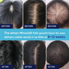 Artimore Minoxidil Foam timeline graphic showing potential gradual improvement