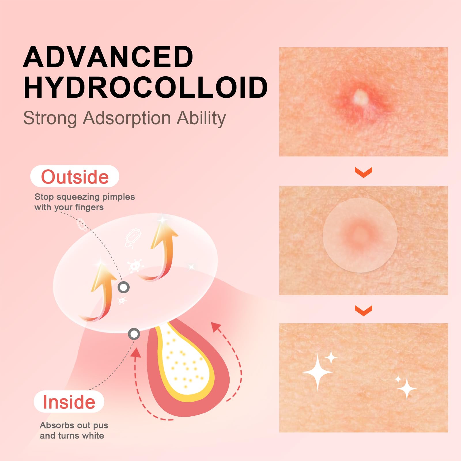 AVJONE hydrocolloid patches with tea tree soothe and absorb fluids