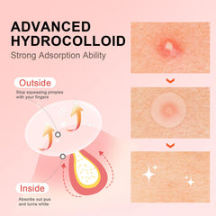 AVJONE hydrocolloid patches with tea tree soothe and absorb fluids