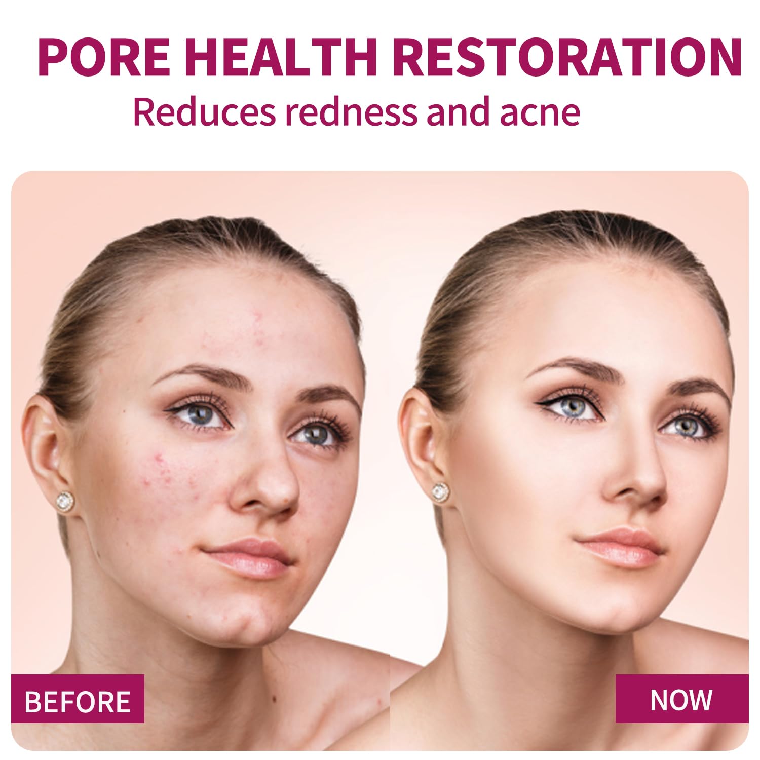 Azelaic Acid Serum on skin shows gentle daily use for balanced tone.