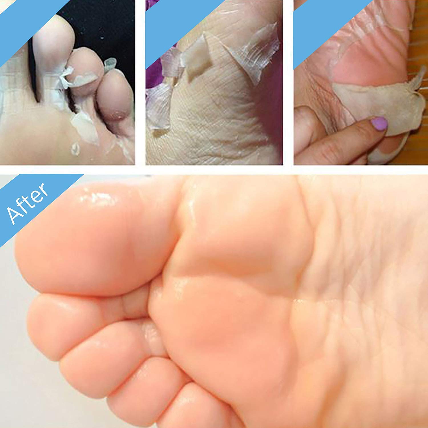 Bealuz soft feet after 1-2 weeks reveal smoother skin.