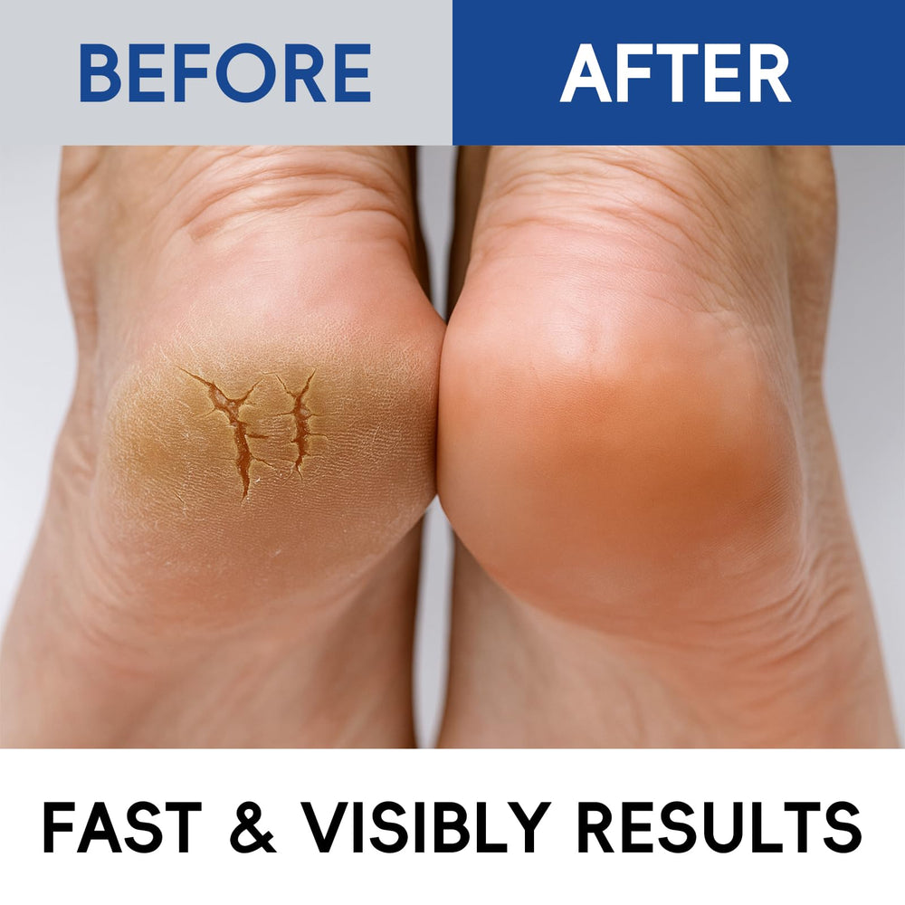 BeauBase callus softening visual indicates smoother skin texture.