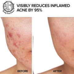 Beauty Facial Extreme Acne Pad application on skin showing pore cleansing.