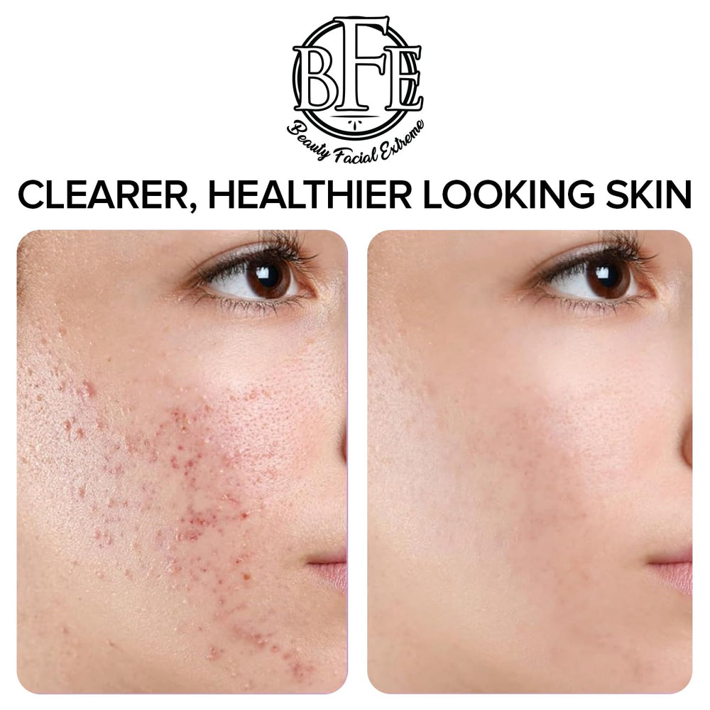 Beauty Facial Extreme Acne Pad close-up of pores benefiting oil regulation.