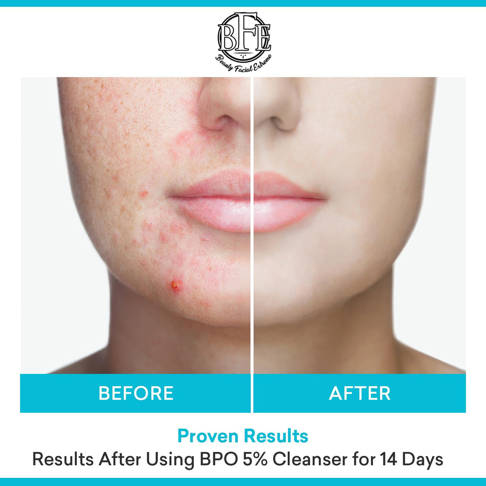 Beauty Facial Extreme deep-pore-action demonstrates deep cleansing for oily skin.