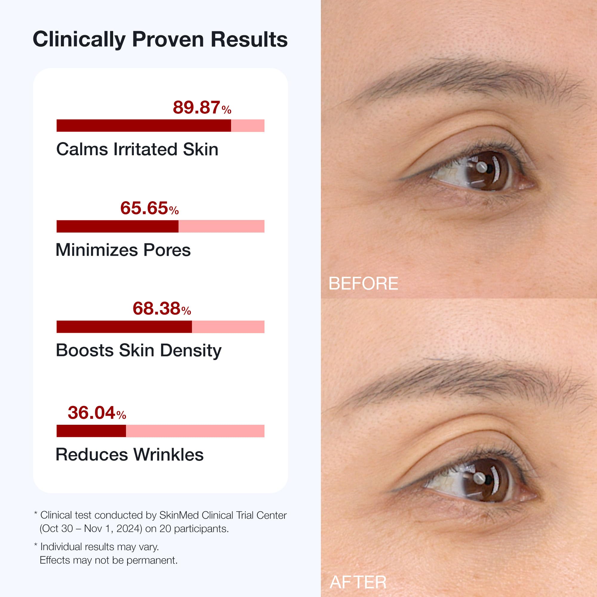 BIOOA PDRN Teedle Shot 300 micro-needling feel on skin for improved texture