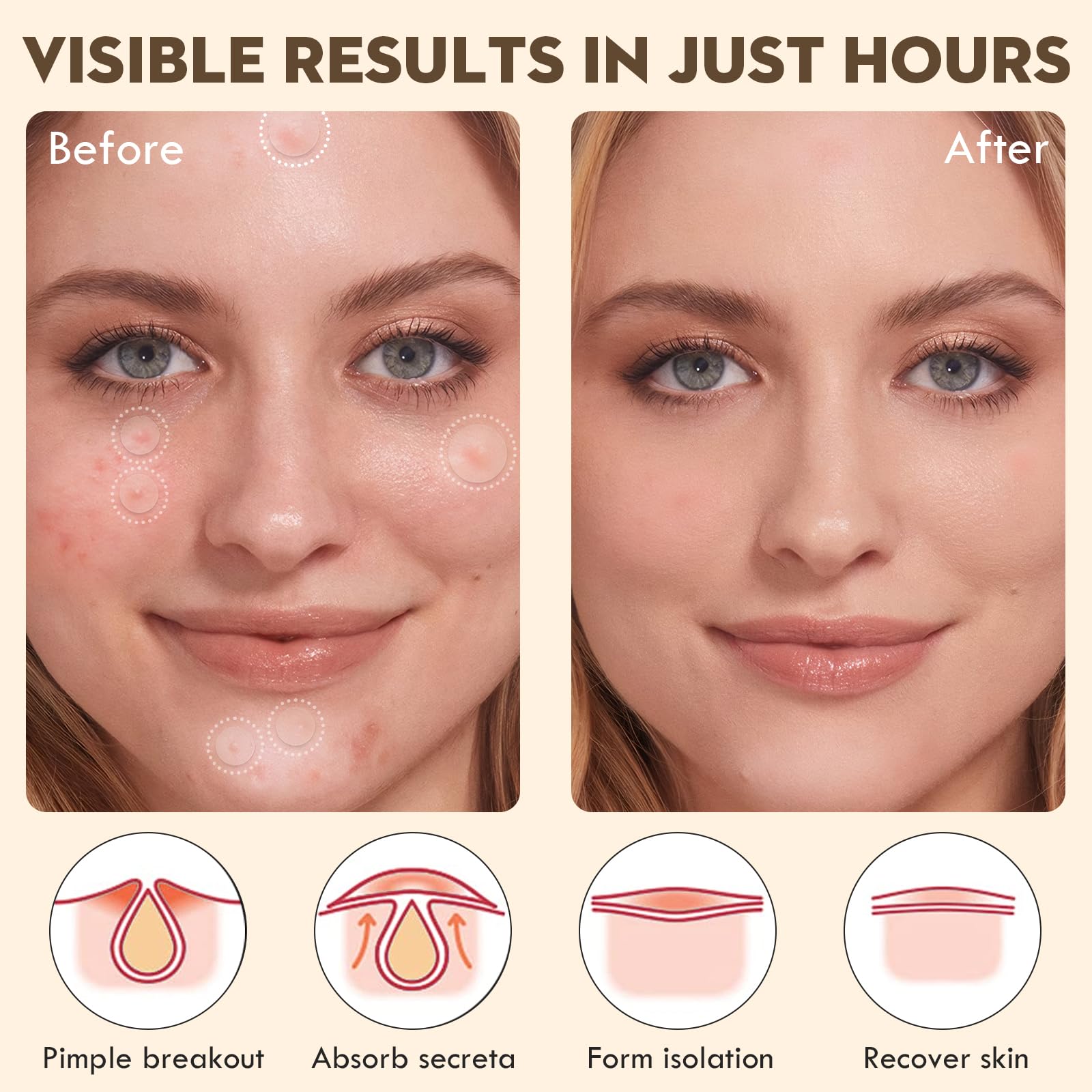 Blorfo salicylic acid acne patches on blemish for targeted care and absorption.