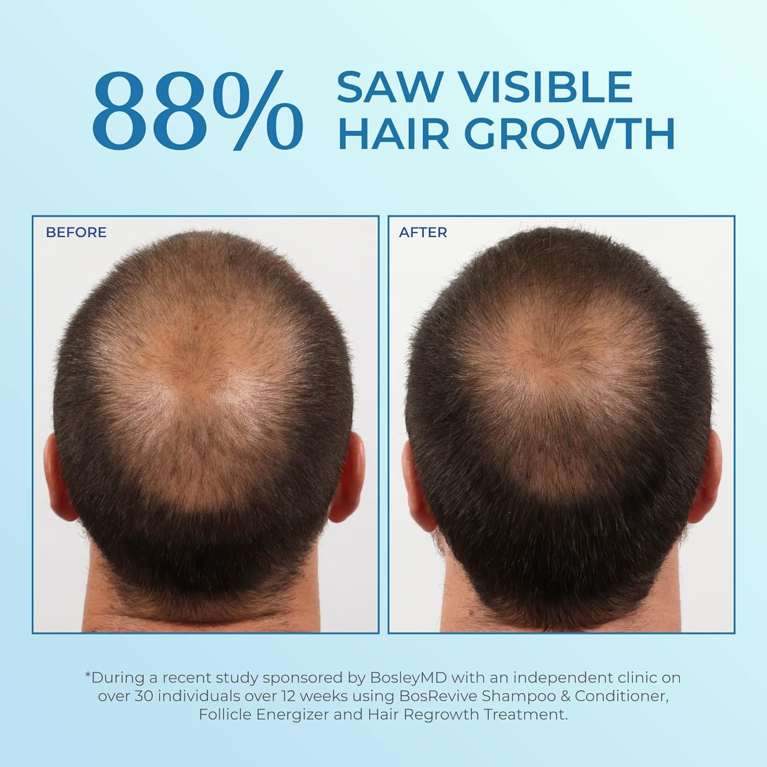 BosleyMD Minoxidil label close-up highlighting the clinical formula for men
