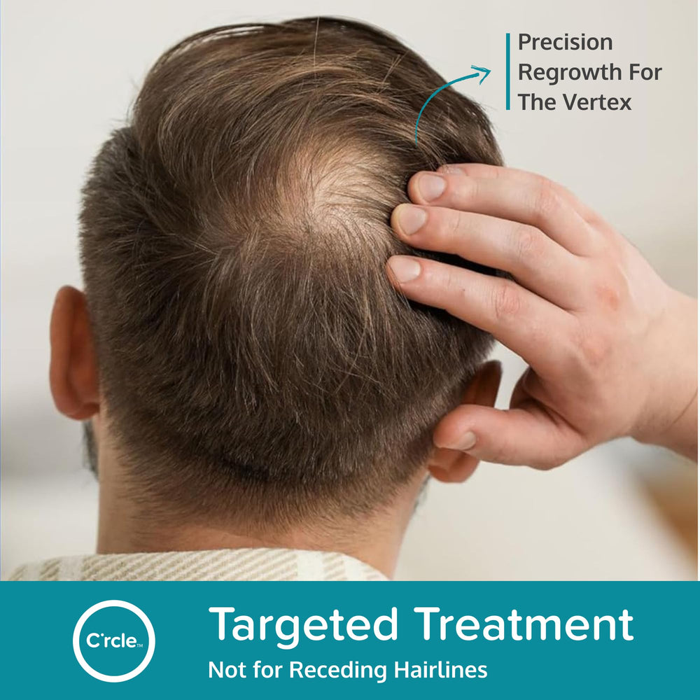 Vertex thinning area treated with C'rcle Minoxidil 5% Foam