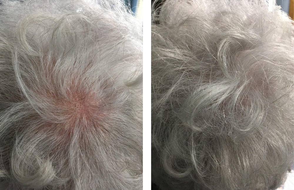 Applying Caboki on the scalp in a thinning area to blend hair.